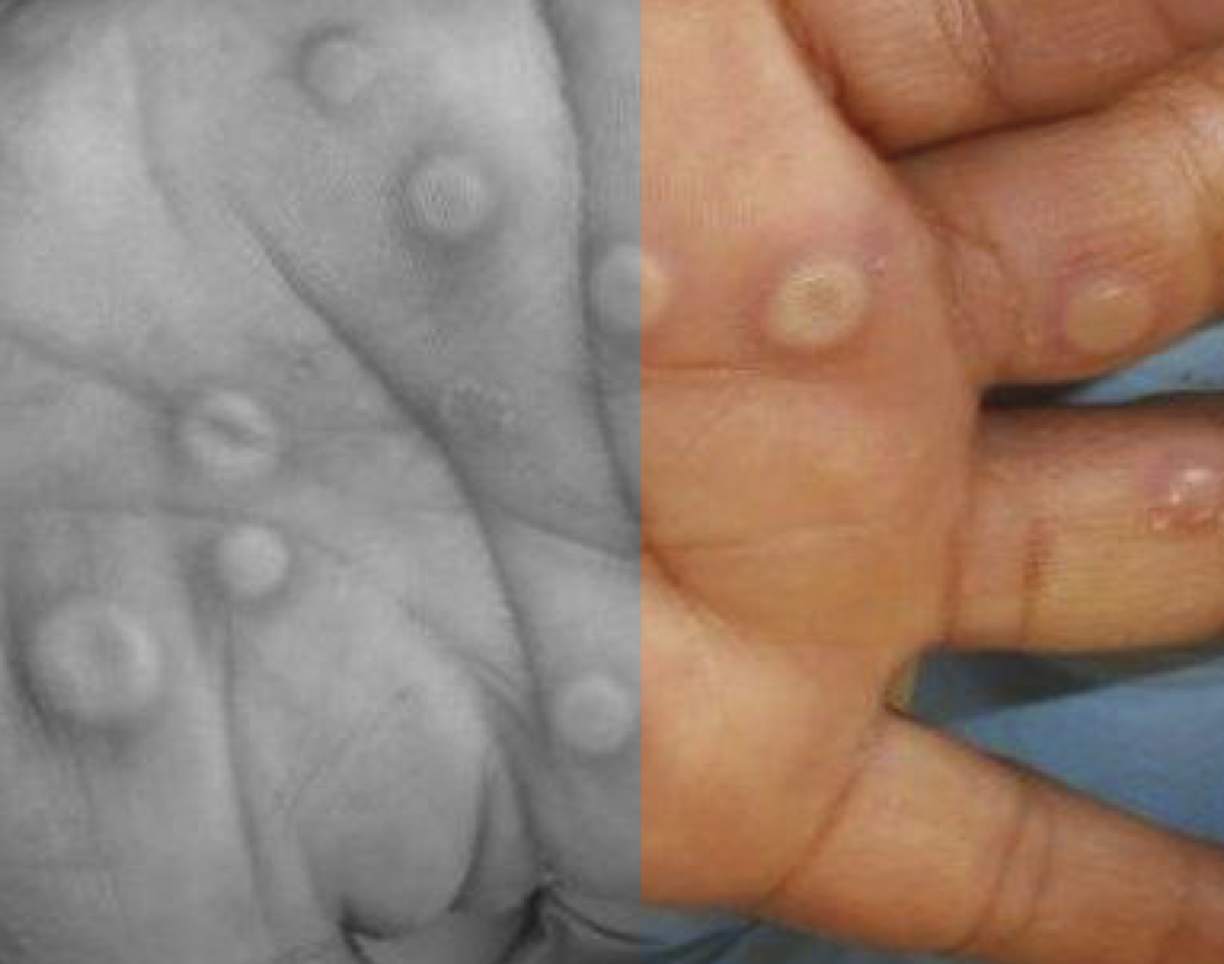 Mpox (Monkeypox): Signs, Symptoms, and Complications