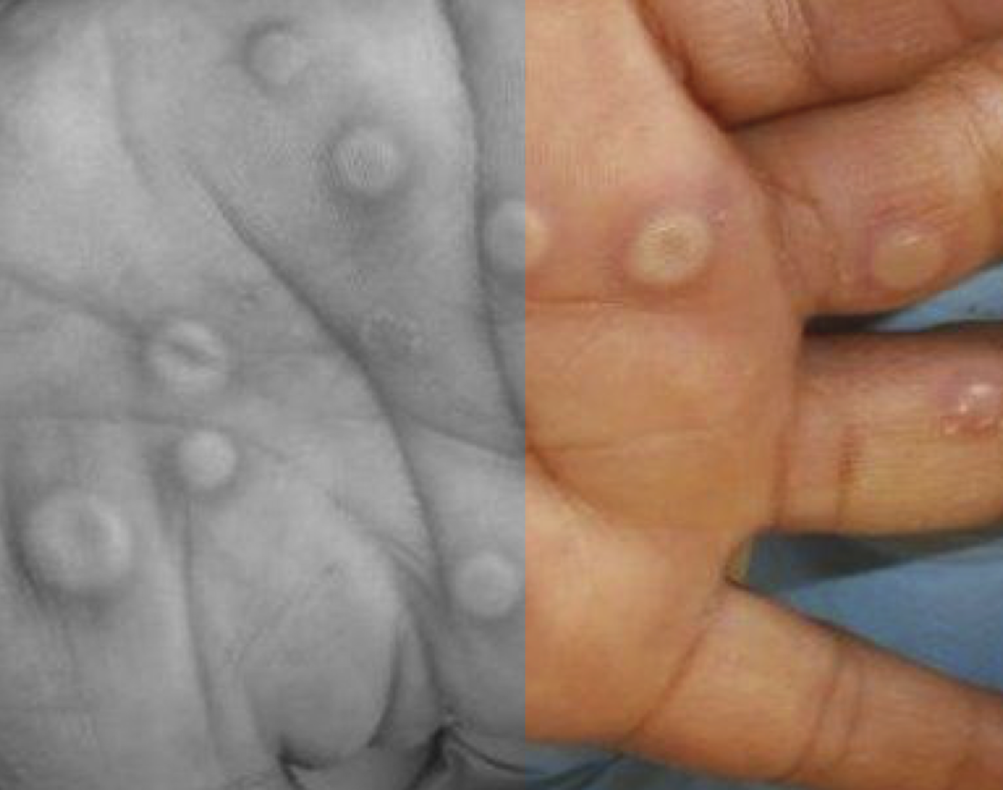 Monkeypox Virus Infection in Humans across 16 Countries — April–June 2022