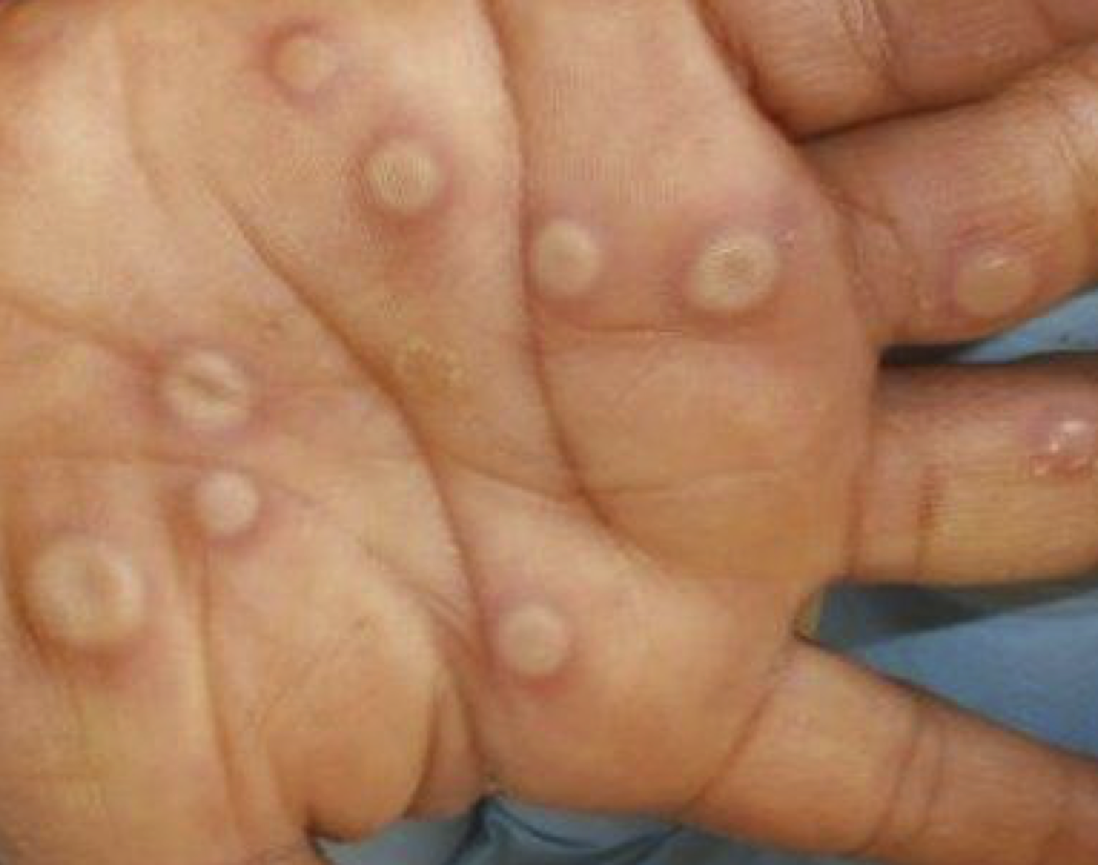Got rashes? How do you know it's Monkeypox, not something else?